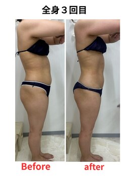 ステラ(Stella)/全身痩身3回目
