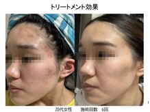 ケイ ビューティー(K BEAUTY)/光フェイシャル