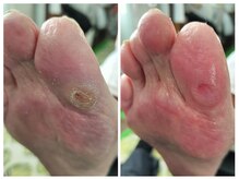 フレッシュフット(FreshFoot)/足のトラブルお任せください