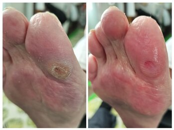 フレッシュフット(FreshFoot)/足のトラブルお任せください