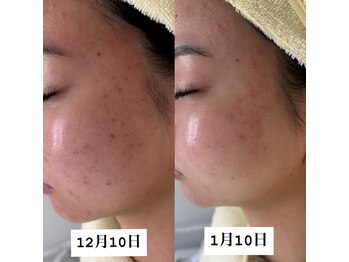 クレア(Claire)/乳酸菌1回、ハーブ1回