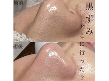 ラルガ 小倉北区魚町本店(Raruga)の雰囲気（エステ人気No.1毛穴洗浄/１回の施術でツルツルに/men's◎/個室）