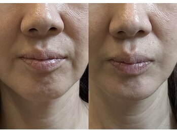 ミルジュ(MiLuJu)/ヘッドスパだけでお顔が上がる！