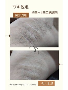 ルアナ(Luana)/業界初の爆抜けモードでツルツル