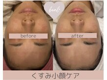 ベアール(beal)/白玉肌フェイシャルエステ3ヶ月