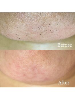 ミミ(mimi)/ビフォーアフター(顎)