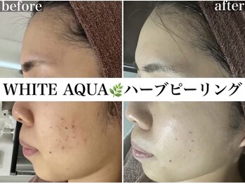 ホワイトアクア 浜松店(WHITE AQUA)/ハーブピーリング/ニキビケア