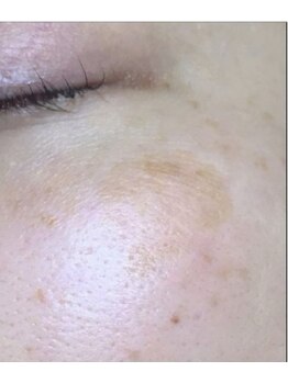 リベル 名古屋(Lebelle:)/ハーブピーリング 名古屋