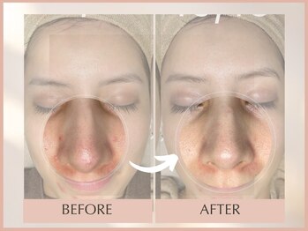 シンスプラス(SINCE+)/ニキビケア徹底フルコース