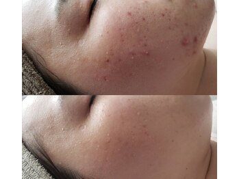 プシュケ(Psyche)/お客様の肌変化