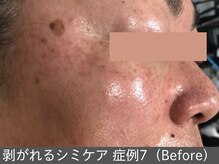 オアシスラグーン(OASIS LAGOON)/シミケア（症例7 before）50代