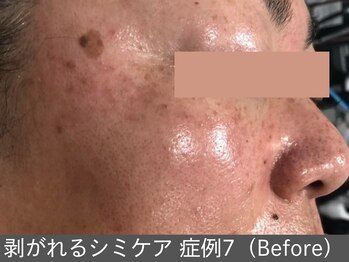 オアシスラグーン(OASIS LAGOON)/シミケア(症例7 before)50代