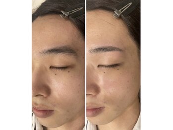 アカヌケ(AKANUKE)/メンズ美眉WAX脱毛