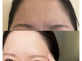 スターラッシュ(Star Lash)/顔脱毛BeforeAfter