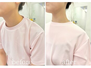 カイロラインメディカル整体 平塚院(Chiro Line)/巻き肩×スマホ首/beforeafter