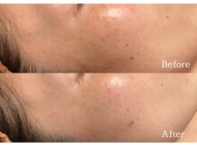 綺麗サロン 脱毛アンドフェイシャル ジュエル(Jewel)/【ポイントシミケア】