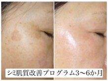 ヌー 栄(nuu)/シミ肌質改善プログラム3～6か月