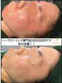 キャンディ 岐阜(CANDi)&nbsp;【剥離あり】リベルハーブピーリングは赤み・美白にも効果発揮◎