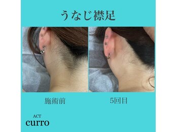 アクト クロ(ACT curro)/【うなじ襟足】脱毛施術例