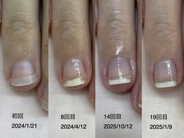 自爪育成