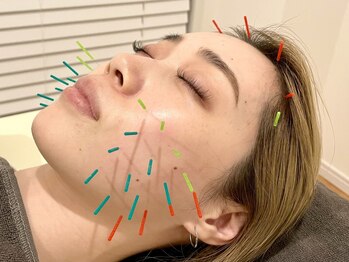 博多鍼灸整骨院 整体院の写真/【初回キャンペーン中】電気を流す美容鍼で顔全体の引き上げ&引き締めを実現!むくみ,肌質改善,眼精疲労に◎