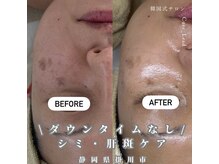 キュアリード(Cure_Lead)/ダウンタイムなし！シミケア