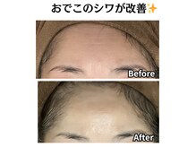 グレースティー 森町 箕面/深いしわが改善！！★★★