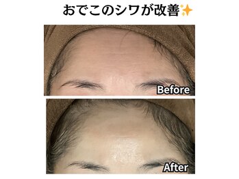 グレースティー 森町 箕面/深いしわが改善！！★★★