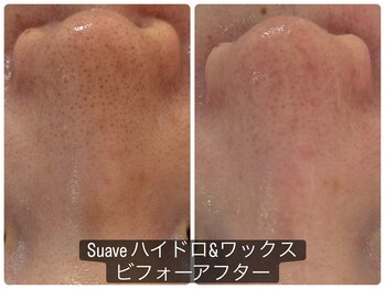 シュアーヴ(Suave)/毛穴ケア