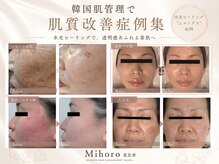 ミホロ 恵比寿(Mihoro)の雰囲気（韓国肌管理で叶える肌質改善症例水光ピーリング/ツヤ/ニキビ）