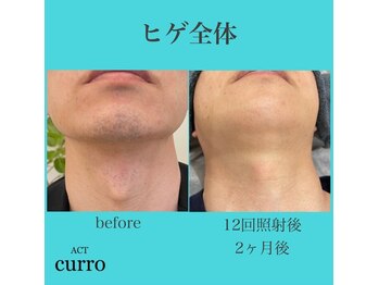 アクト クロ(ACT curro)/【ヒゲ全体】脱毛施術例