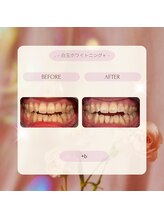 プラスビー 2号店(+b)/ホワイトニングビフォーアフター