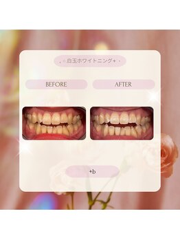 プラスビー 2号店(+b)/ホワイトニングビフォーアフター