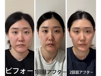 アクアナチュラ(ACQUANATURA)/2回目は更にスッキリ