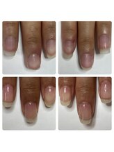 マニュコクーン(ManuCocoon)/爪育成　深爪　巻き爪　大阪市