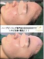 キャンディ 岐阜(CANDi)&nbsp;【剥離あり】リベルハーブピーリングで素早くニキビ肌とさよなら