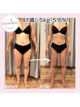 シーディーエム(cdm)/イヤーセラミック3ヶ月後