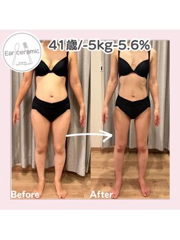 シーディーエム(cdm)/イヤーセラミック3ヶ月後