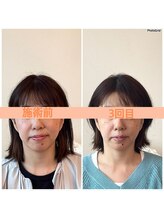 リフェイスフサエ(ReFace Fusae)/お顔の変化