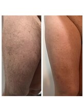 カノア(KANOA)/メンズ脱毛