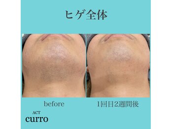アクト クロ(ACT curro)/【ヒゲ全体】脱毛施術例