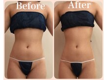 トータルビューティサロン クイーン(Queen)/●引き締め●