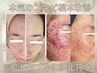 人気NO.3★本気改善【ニキビケア特化はこれ！】ハーブピーリング￥15500