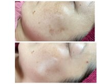 エイジングケア/フェイシャルエステ