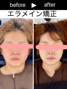 エレヴィザ トウキョウ 恵比寿院(ELVISA TOKYO)/エラ・フェイスラインの大き改善