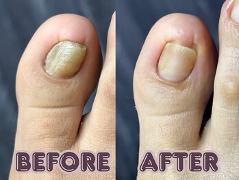 ポドロ ウィズ ニコルル 大阪天満店(PoDoLo with Nicolulu)/【分厚い爪】フットケア大阪梅田