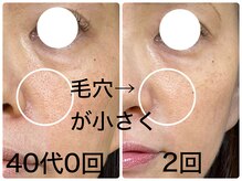皇漢堂鍼灸療院/最新美容鍼【ダーマ鍼】での変化
