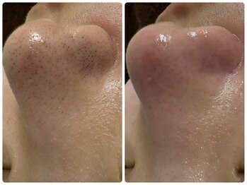 ケー(K)/1回でこの効果「毛穴洗浄」