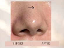 シンスプラス(SINCE+)/毛穴徹底フルコース