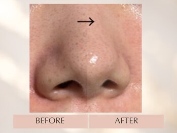 シンスプラス(SINCE+)/毛穴徹底フルコース